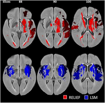 Prediction of Clinical Outcomes in Acute Ischaemic Stroke Patients: A Comparative Study